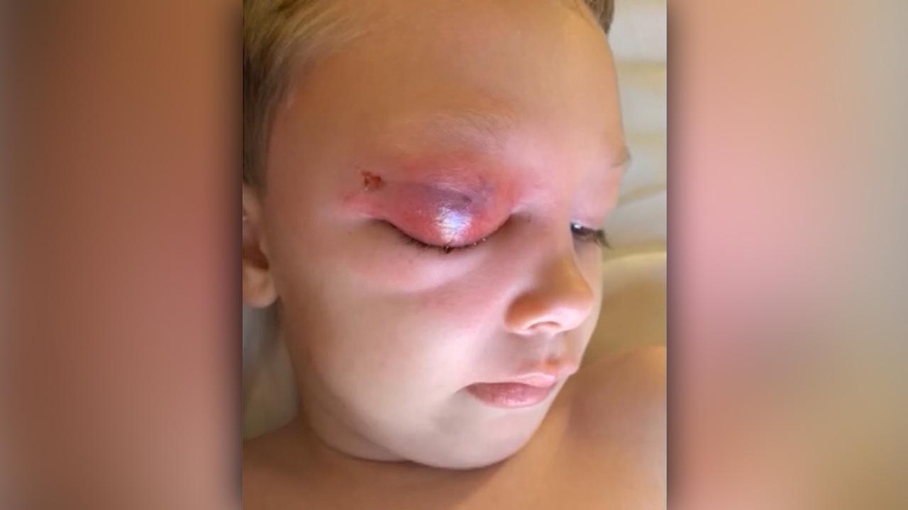 Doctors work to save Florida boy's eye after small cut becomes infected on cruise