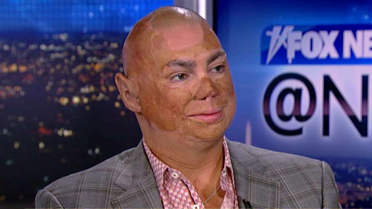 Iraq Veteran Talks Surviving Injuries Inspiring Others Fox News Video Iraq Veteran Talks Surviving Injuries Inspiring Others Fox News Video