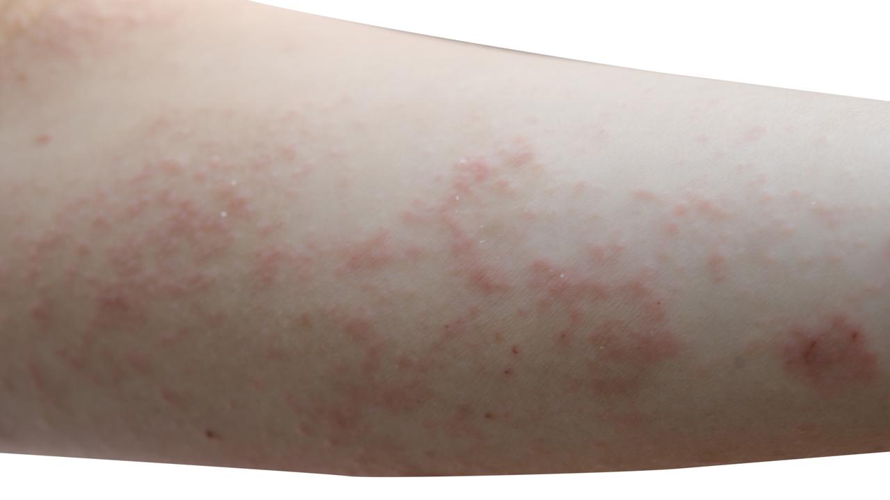 Scabies Rash On Arms