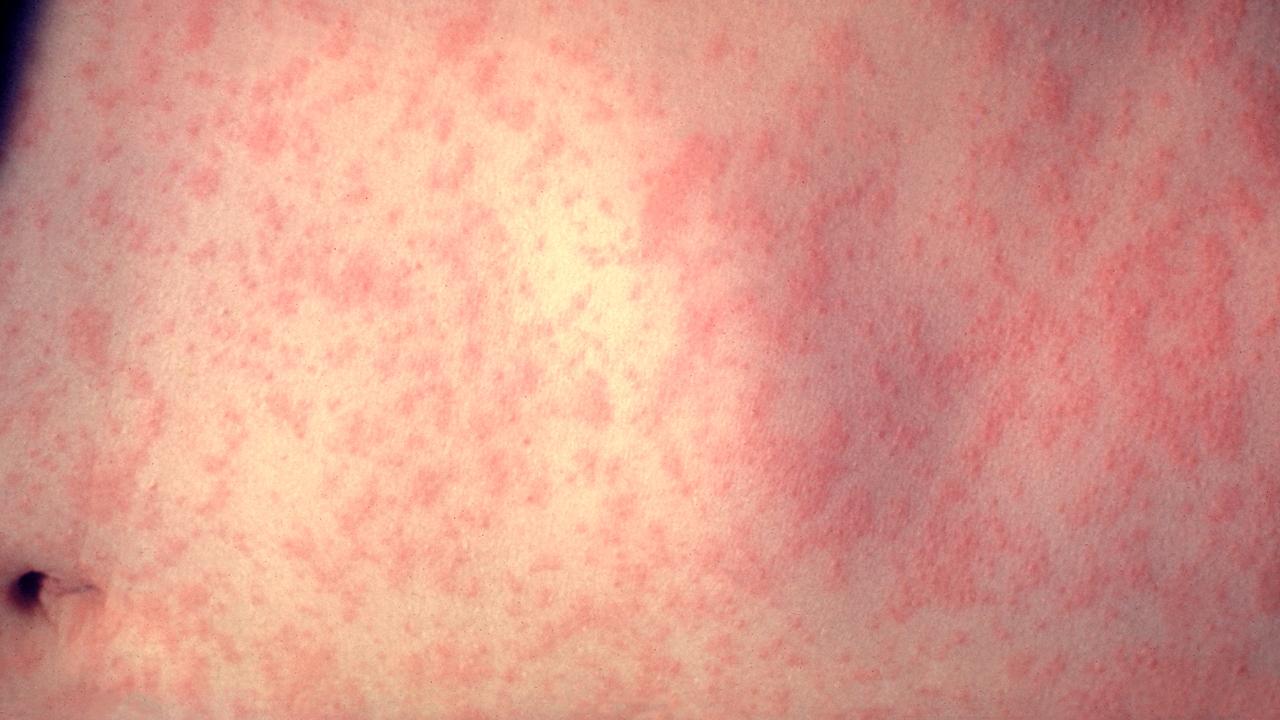 Measles cases in US highest since 1992, CDC says - Fox News thumbnail