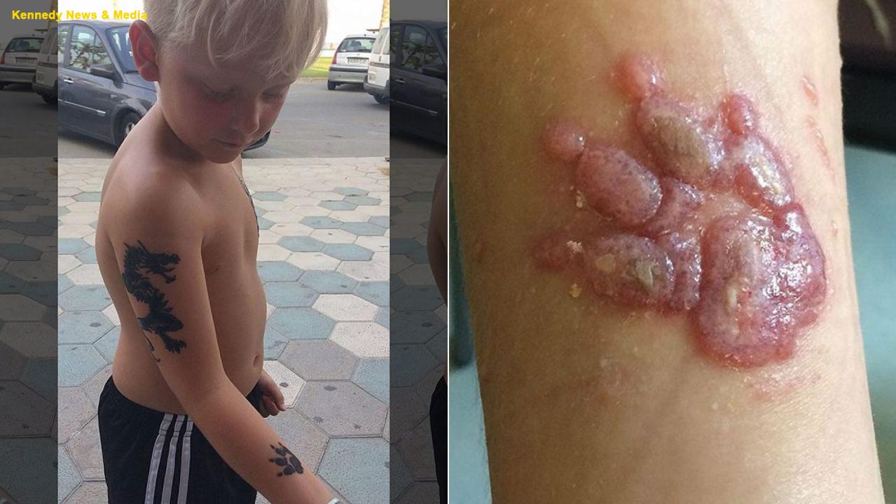 Boy, 8, left scarred after allergic reaction to henna tattoo | Fox News